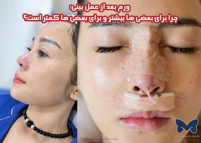 ورم بعد از عمل بینی؛ چرا برای بعضی ها بیشتر و برای بعضی ها کمتر است؟